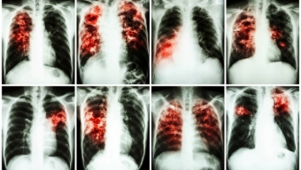Tubercolosi: entro il 2050 ucciderà 75 milioni di persone e costerà $16.700 miliardi