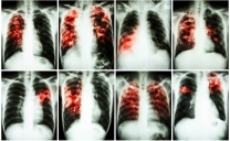 Tubercolosi: entro il 2050 ucciderà 75 milioni di persone e costerà $16.700 miliardi